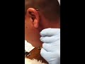 Pimple squirts
