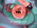 Retratamiento de endodoncia con 3 conductos mesiales