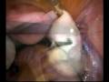 Laparoscopic ovarian drilling