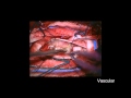 Intradural Schwannoma L2