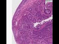 Histopathology Cervix-- Squamous cell carcinoma Histopathology Cervix-- Squamous cell carcinoma