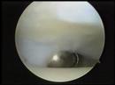 Arthroscopic adventure