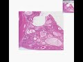 Histopathology Endometrium--Endometrial polyp
