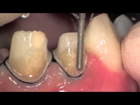TOOTH!! - Three full ceramic restorations + one direct restoration. Endodontic treatment, preparation for full crowns, impression and final result. To visit our hands-...