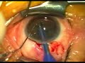 ????cataract? ????cataract?