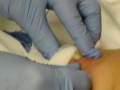 MRSA deadly staff infection (survived)