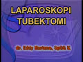 Laparoskopi Tubektomi