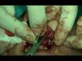 maxillofacial surgery video preview 16