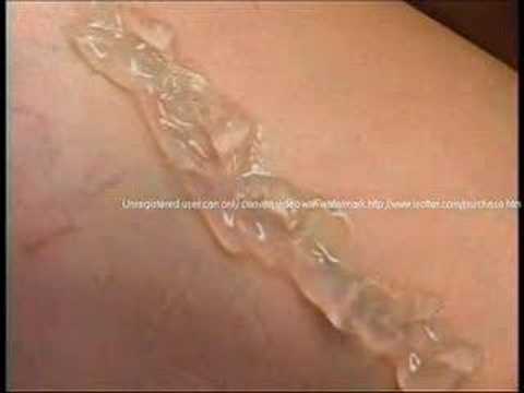 Bryn Mawr Radnor Spider Veins Dr ...