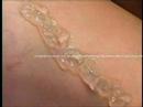 Bryn Mawr Radnor Spider Veins Dr Kirksey Penn Presbyterian Bryn Mawr Radnor Spider Veins Dr Kirksey Penn Presbyterian