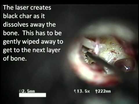 how to cure otosclerosis