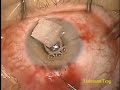 Trabeculectomy Mitomycin C Right Eye