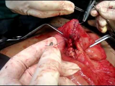 Anastomosis - A case of gun shot wound abdomen with multiple small gut perforation in the jejuno-ileal junction area. segmental resection with end to end anastomosis done ...