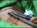 neck cannulation neck cannulation