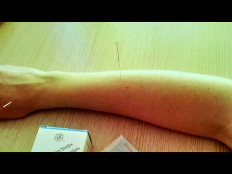 Akupunkturnadel