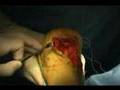 Achilles Repair, Tendon Transfer & Spur Removal Part2