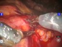 da Vinci/Robotic Aortic Lymph Node Dissection with HD Optics da Vinci/Robotic Aortic Lymph Node Dissection with HD Optics