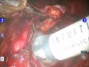 da-vinci-s-robotic-aortic-lymph-node-dissection-with-hd-optics.html