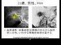 Typical FNH, focal nodular hyperplasia, central scar