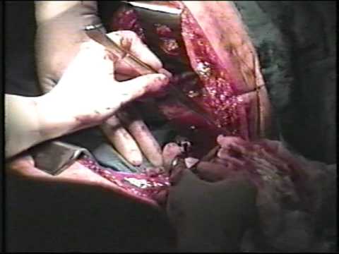 how to repair aortic aneurysm