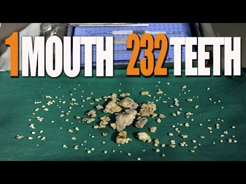 232 Teeth Extracted From Teen's Mouth!!!