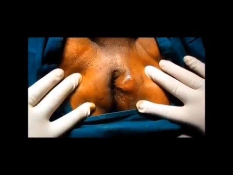how to drain breast abscess
