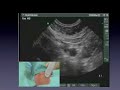 Ultrasound in Regional Anaesthesia