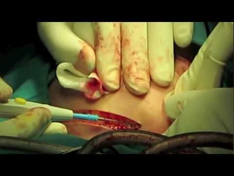 how to harvest iliac bone graft