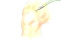 videos de Malpractice Medical Arthroscopic Meniscus Repair of Knee Surgery 2