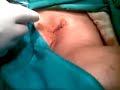 Excision of Sebaceous Cyst under LA&application of subcuticular suture PART 2 - Dr Narotam Dewan