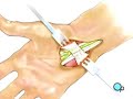 PreOp Patient Education: Carpal Tunnel Syndrome Repair Surg
