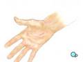 PreOp® Patient Education: Carpal Tunnel Syndrome Repair Surg