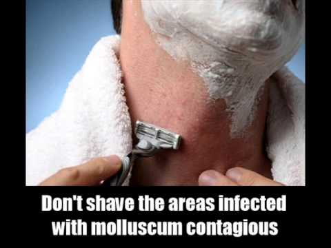 how to cure molluscum contagiosum