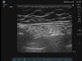 Ultrasound-Guided Intercostal Nerve Block for Breast Surgery