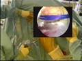 Arthroscopy: Shoulder ACJ dislocations and fracture fixation
