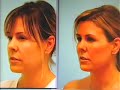 PLASTIC-SURGERY-FAT-