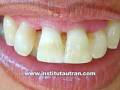 videos de Estética dental: malposición superior (problema y solución)