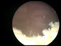 Holmium Laser Ablation of Prostate (HoLAP)