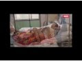 198 pound tumor - YouTube