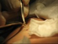 Removal of steatocystoma multiplex