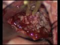Petroclival meningioma - Right-retrosigmoid approach