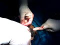 MEGA  BLADDER STONE OPERATION  SUCCESSFULL AT RIDDHI SIDDHI HOSPITAL.wmv