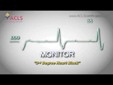how to treat 3rd degree heart block