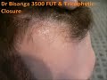 BHR Clinic 3537 FUT & Tricophytic Closure