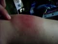 Bug Bite Bug Bite