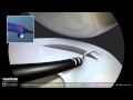 ConMed Sequent Meniscal Repair