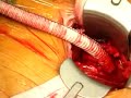 Live Webcast: Min Inv. Repair of Thoracic Aortic Aneurysm  Heart Diseases Aorta
