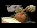 Photofacial Treatment in Austin, TX at Escobedo Skin Center