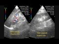 Left Renal Infarction - Pocket Ultrasound Bedside Left Renal Infarction - Pocket Ultrasound Bedside