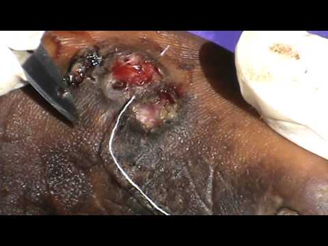 how to treat jiggers